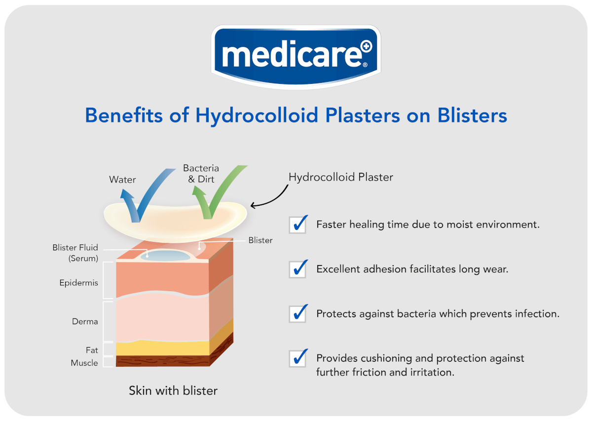 Benefits of Hydrocolloid Plasters on Blisters