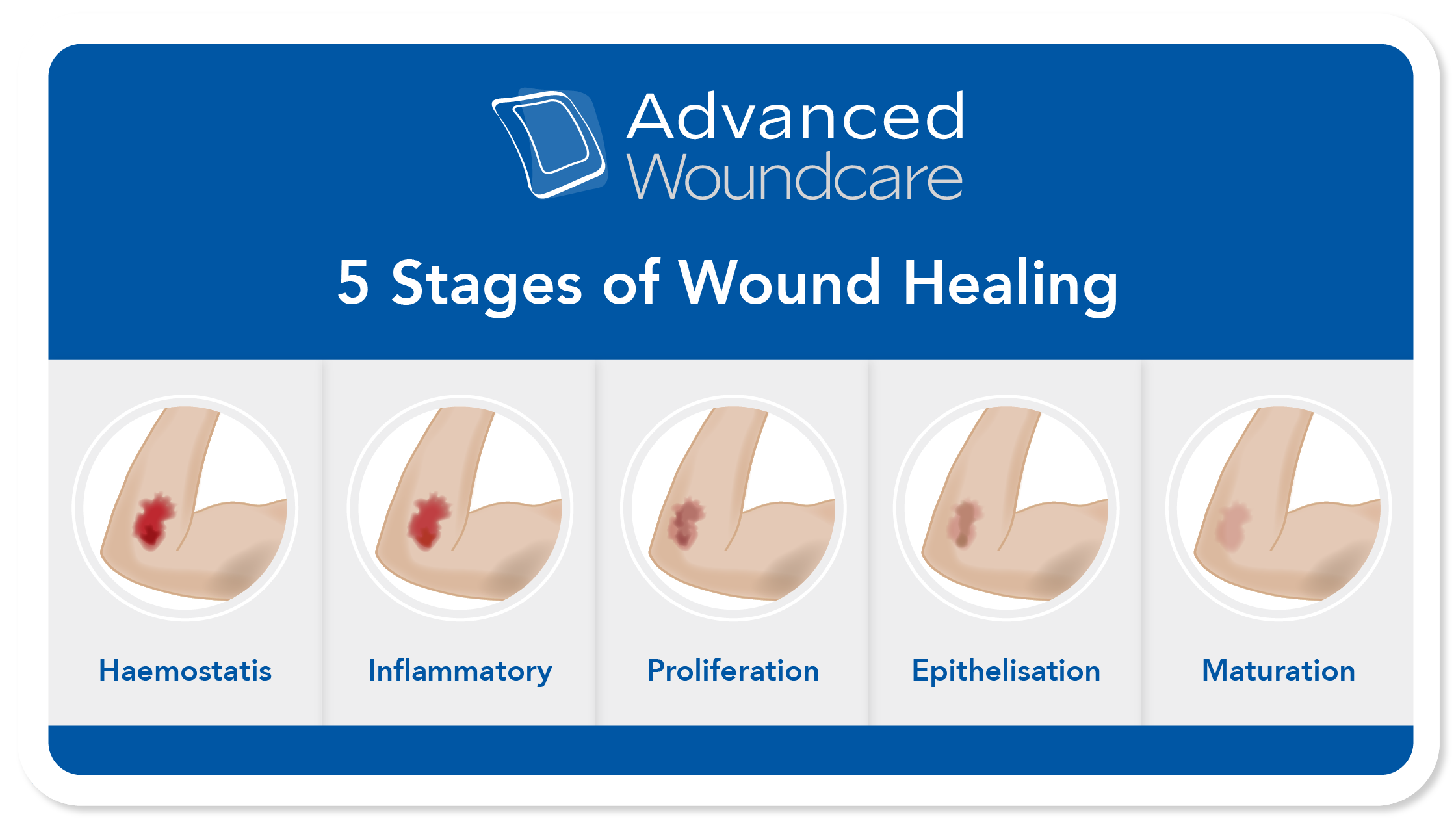 5 Stages of Wound Healing