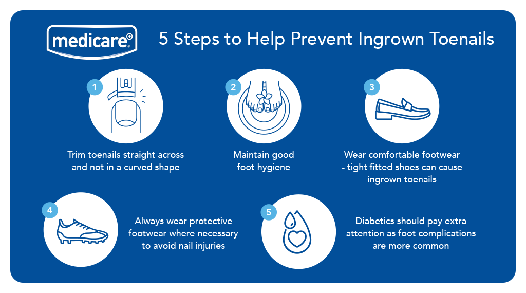 Medicare Footcare: 5 Steps to Help Prevent Ingrown Toenails