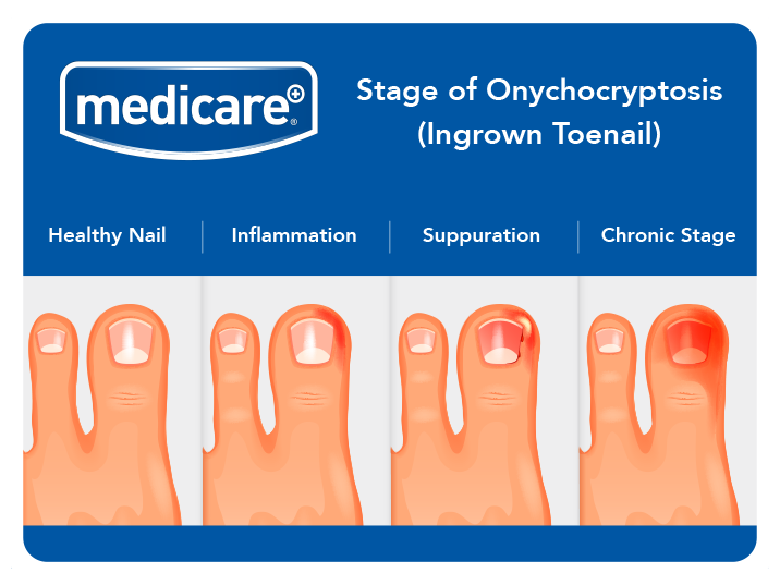 Medicare Footcare: Stages of Ingrown Toenail