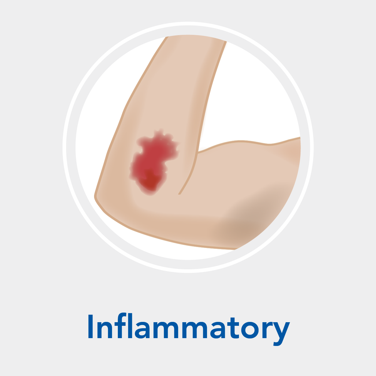 Stage 2: Inflammatory Phase