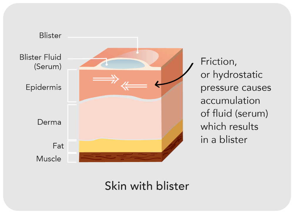 Skin with Blister Diagram