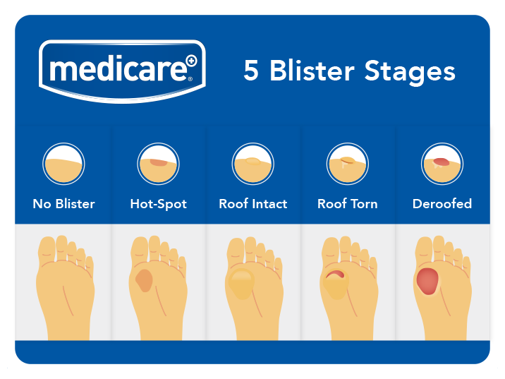 The 5 Stages of Blisters