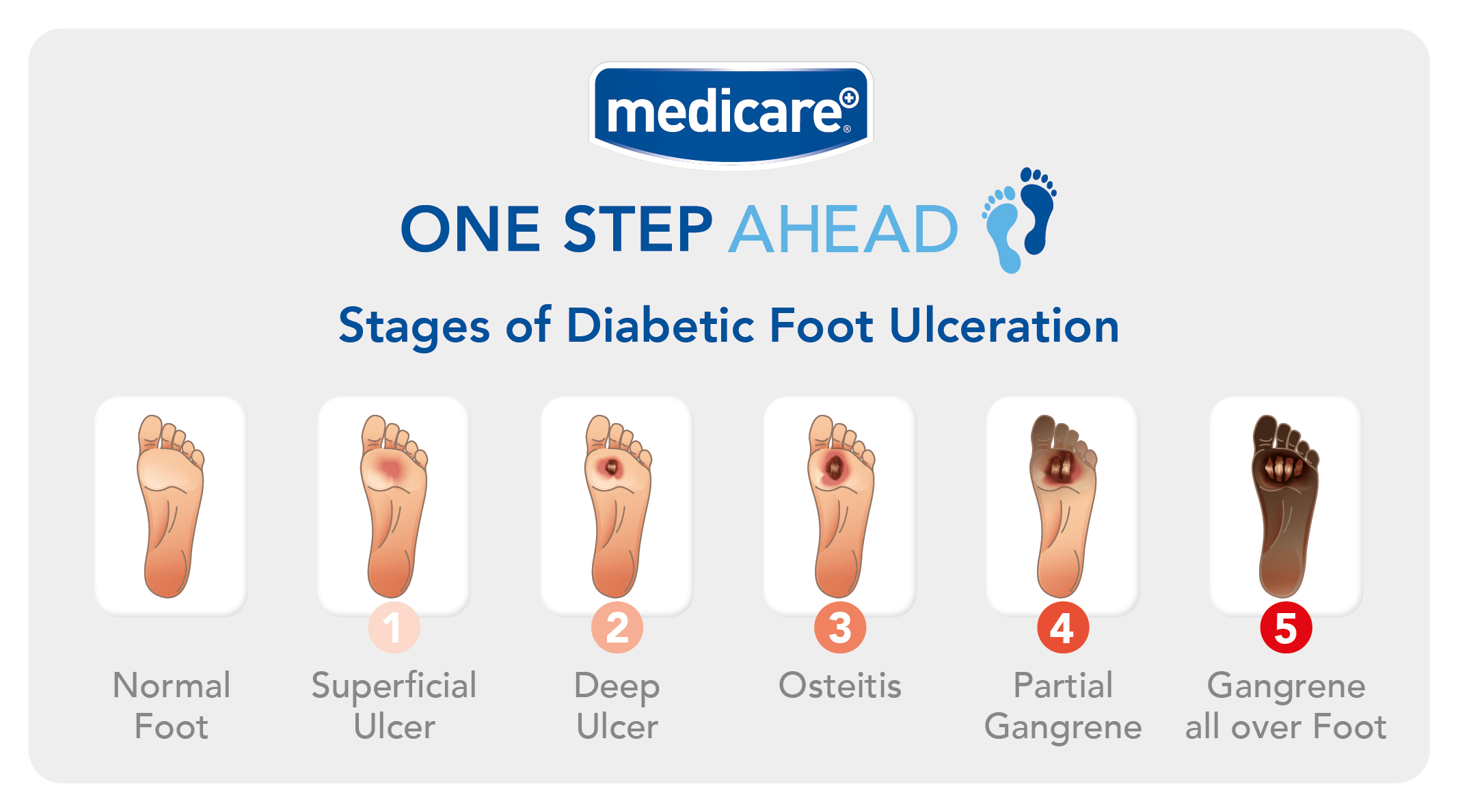 20+ Diabetic Foot Ulcer Stock Photos, Pictures & Royalty-Free Images -  iStock | Pressure ulcer, Wound, Gangrene