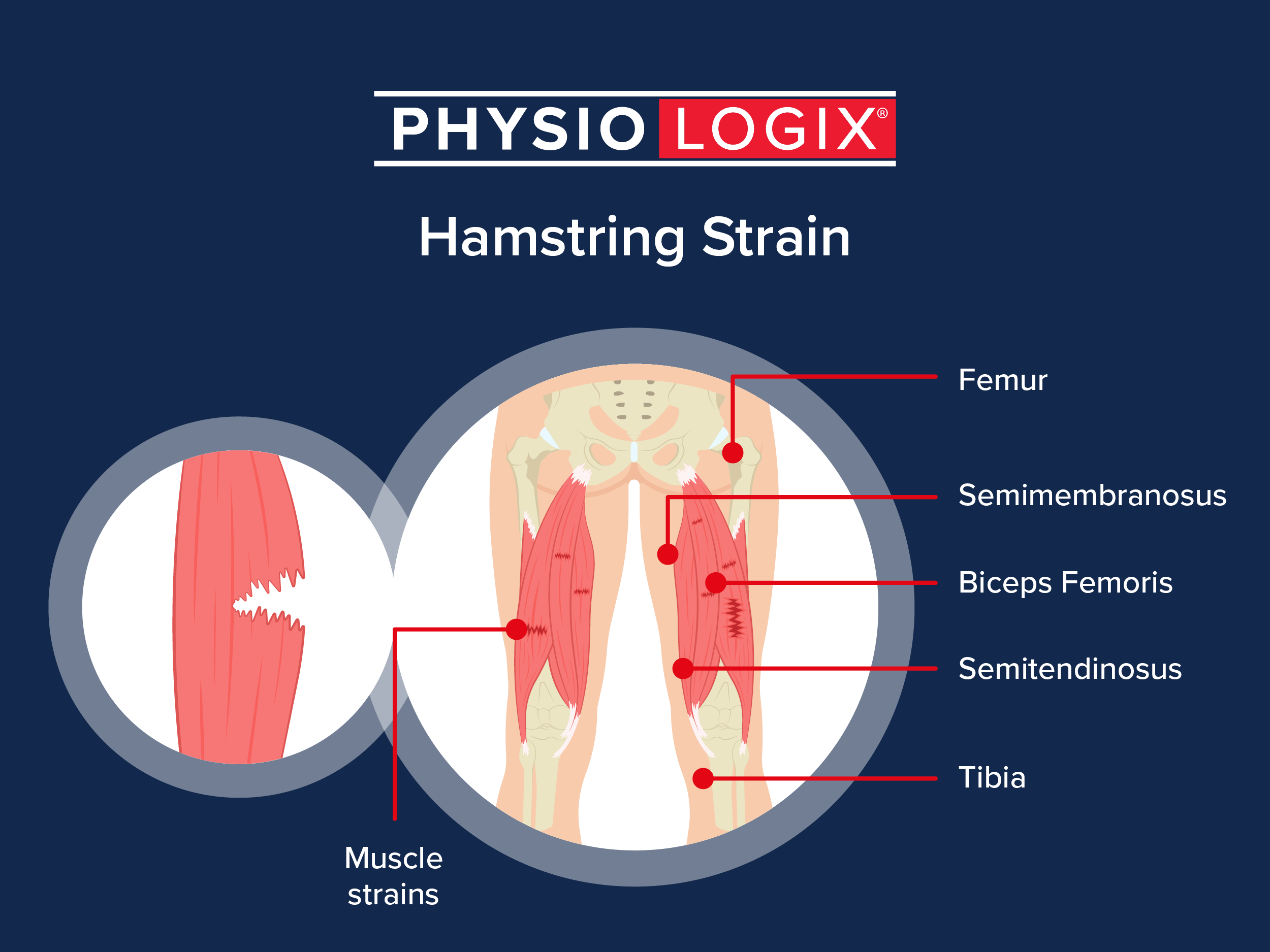 Hamstring Anatomy Diagram